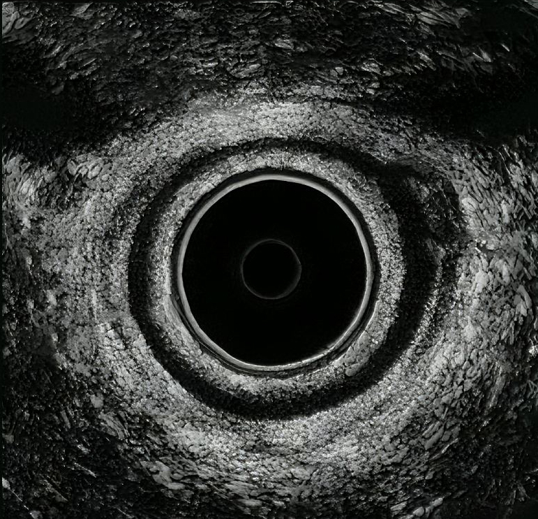 Ενδοορθικός (Ενδοπρωκτικός) Υπέρηχος 1 Ενδοορθικός (Ενδοπρωκτικός) Υπέρηχος