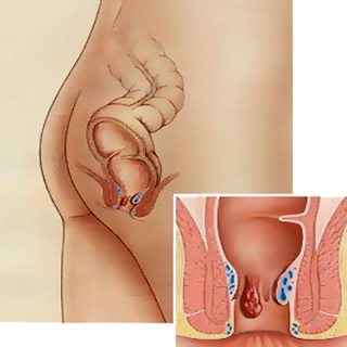 Αιμορροΐδες - Μορφές και Στάδια 1 Αιμορροΐδες - Μορφές και Στάδια