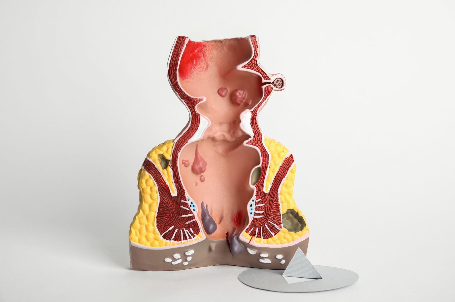 Αιμορροΐδες Αίτια, συμπτώματα και σύγχρονη θεραπεία με laser, σε 15 λεπτά χωρίς πόνο και επιπλοκές! 14 Αιμορροΐδες αίτια