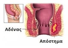 Περιεδρικό Απόστημα 1 Περιεδρικό Απόστημα