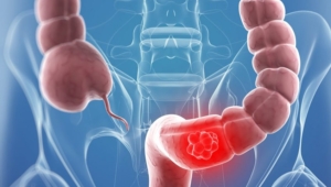 Ποια είναι η Σταδιοποίηση της Νόσου; 1 Ποια είναι η Σταδιοποίηση της Νόσου;