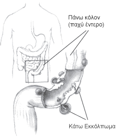 Τι είναι η Εκκολπωματίτιδα; 2 Τι είναι η Εκκολπωματίτιδα;