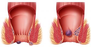 Αιμορροΐδες - Θεραπεία με laser 18 Αιμορροΐδες - Θεραπεία με laser