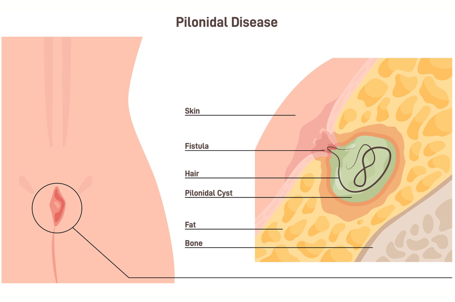κύστη κόκκυγος ανάρρωση