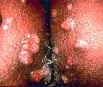 Υπάρχουν διαφορετικά Είδη Κονδυλωμάτων Πρωκτού;