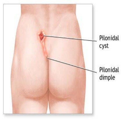 Κύστη κόκκυγα, συμπτώματα, θεραπεία - Proctoclinic.gr 1 Κύστη κόκκυγα, συμπτώματα, θεραπεία - Proctoclinic.gr