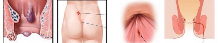 Σύγχρονη θεραπεία με laser για τις ορθοπρωκτικές παθήσεις 15 Σύγχρονη θεραπεία με laser για τις ορθοπρωκτικές παθήσεις