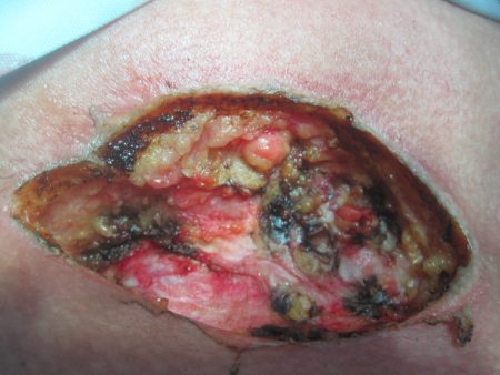 Παλιά κλασσική μέθοδος αντιμετώπισης της Κύστης Κόκκυγα 1 Παλιά κλασσική μέθοδος αντιμετώπισης της Κύστης Κόκκυγα