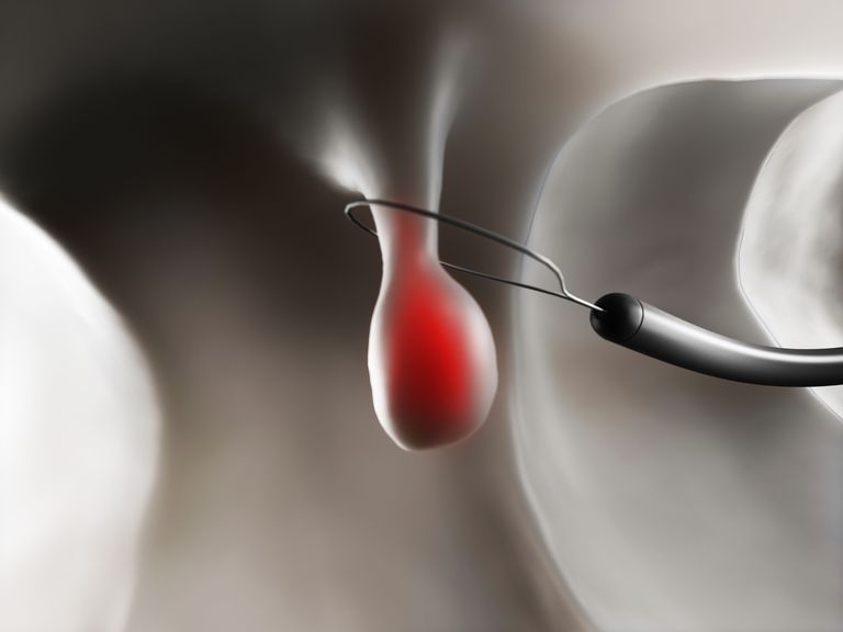 Πολύποδες Εντέρου: Τύποι, Συμπτώματα, Αντιμετώπιση 17 Πολύποδες Εντέρου: Τύποι, Συμπτώματα, Αντιμετώπιση