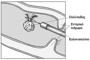 Πως Θεραπεύονται οι Πολύποδες; 1 Πως Θεραπεύονται οι Πολύποδες;