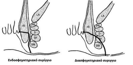 Συρίγγιο & Θεραπεία με Laser 17 Συρίγγιο & Θεραπεία με Laser