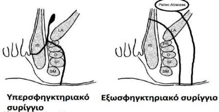 Συρίγγιο & Θεραπεία με Laser 18 Συρίγγιο & Θεραπεία με Laser
