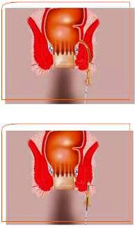 Συρίγγιο & Θεραπεία με Laser 19 Συρίγγιο & Θεραπεία με Laser
