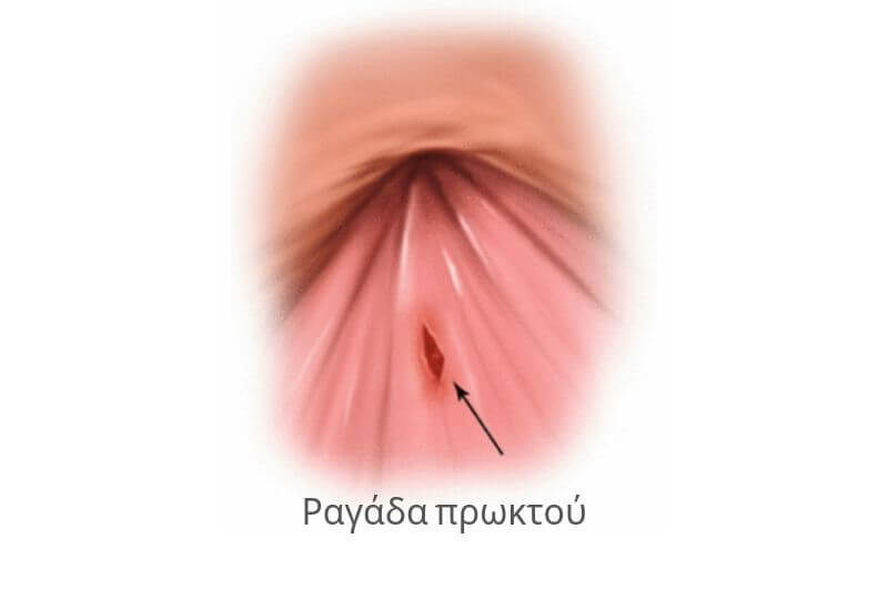 Ραγάδα πρωκτού: Από τι προκαλείται και πώς μπορεί να θεραπευτεί με τη χρήση laser 14 Ραγάδα πρωκτού: Από τι προκαλείται και πώς μπορεί να θεραπευτεί με τη χρήση laser