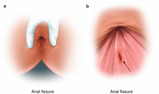 Τι ονομάζεται Ραγάδα Δακτυλίου; 1 Τι ονομάζεται Ραγάδα Δακτυλίου;